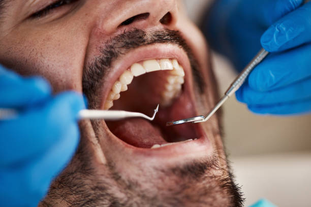 Best Emergency Wisdom Tooth Extraction in Bellmawr, NJ